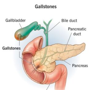 Gallbladder stones