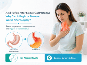 Acid reflux after sleeve gastrectomy showing stomach contents flowing back into the oesophagus